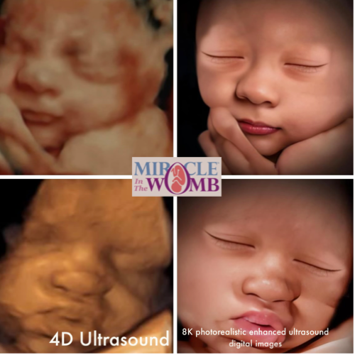 3d ultrasound okc 3d 4d ultrasound 5d ultrasound HDlive 8K Enhanced Imaging ultrasound near me